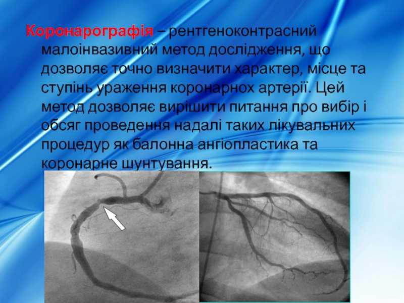 Коронарография. что такое катетеризация сердца?