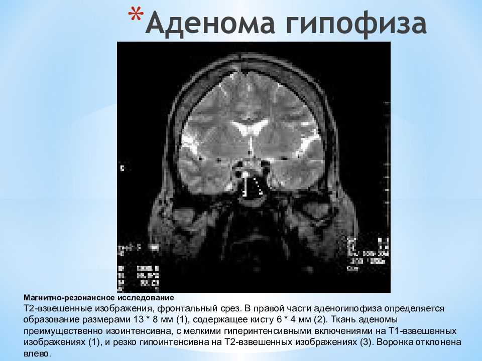 Качественная диагностика и лечение аденомы (опухоли) гипофиза
