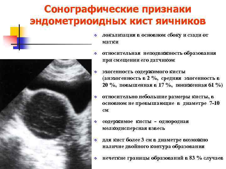 Киста яичника ‒ причины и симптомы