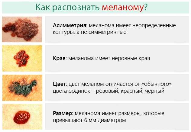 Врач по родинкам