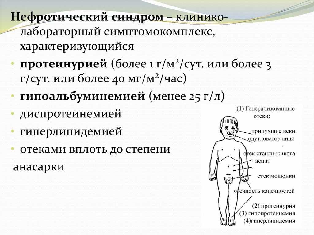 Нефротический синдром