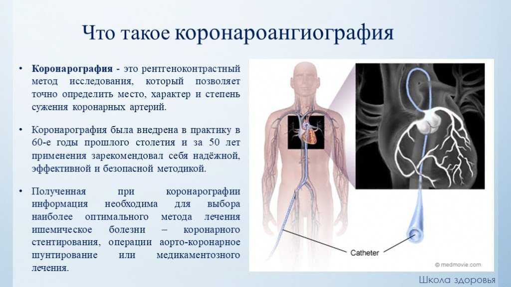 Коронарография сосудов сердца: что это такое, как проводят, когда назначают?