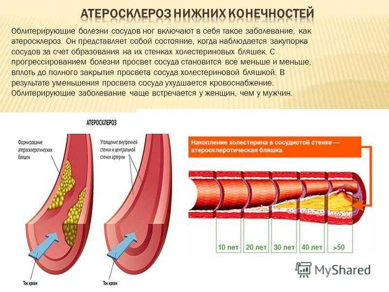 Атеросклероз
