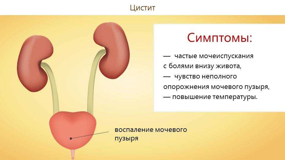 Как лечить цистит у женщин?