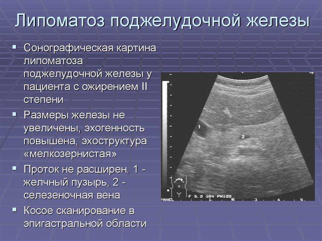 Стеатоз печени и поджелудочной железы. здоровье печени