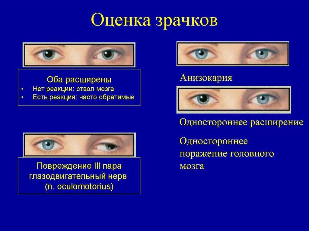 Спонтанные движения глаз при головокружении