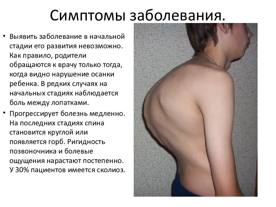 Кифоз позвоночника — лечение, симптомы, причины киев, марбелья