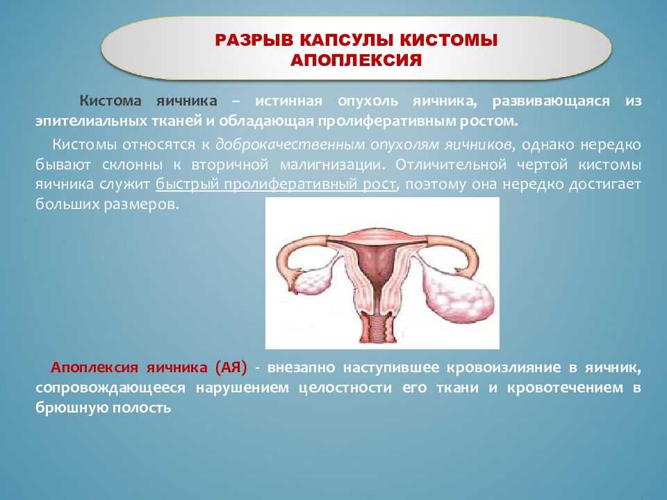 Причины разрыва яичника у женщин