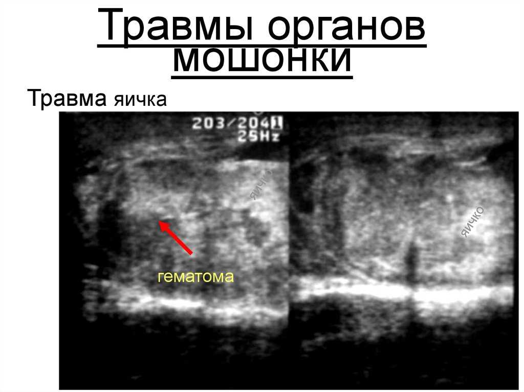 Травма яичка — удар, сбивающий мужчину с ног | университетская клиника