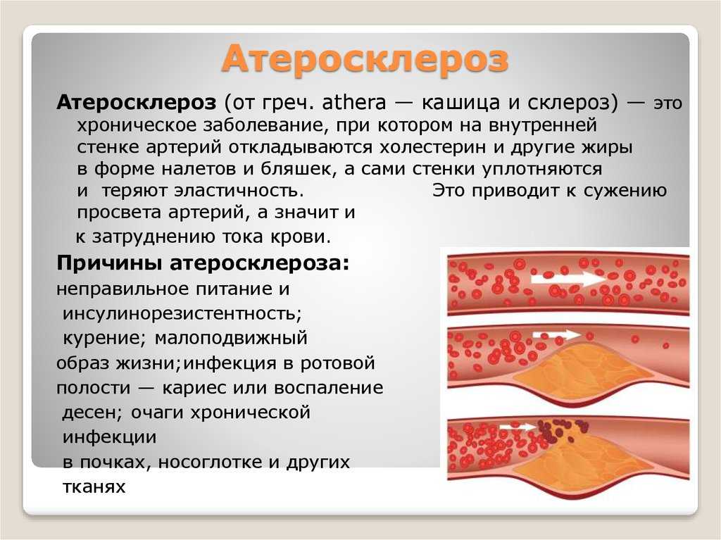 Атеросклероз ног – не приговор: мы обязательно вам поможем! с нашей помощью вы забудете, что такое атеросклероз сосудов ног