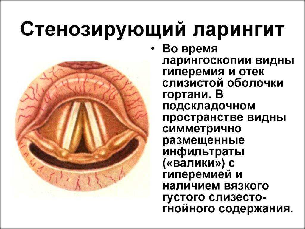 Ларингит у взрослых и детей: причины, симптомы, лечение – эл клиника