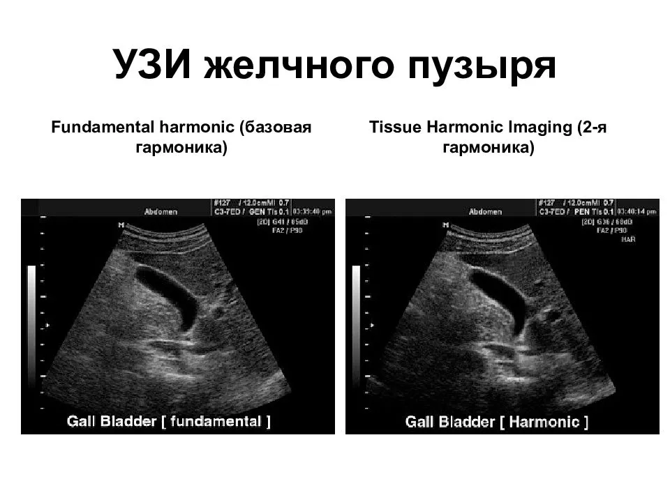 Увеличение печени