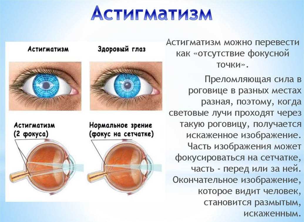 Астигматизм глаз у взрослых: лечение, причины, степени