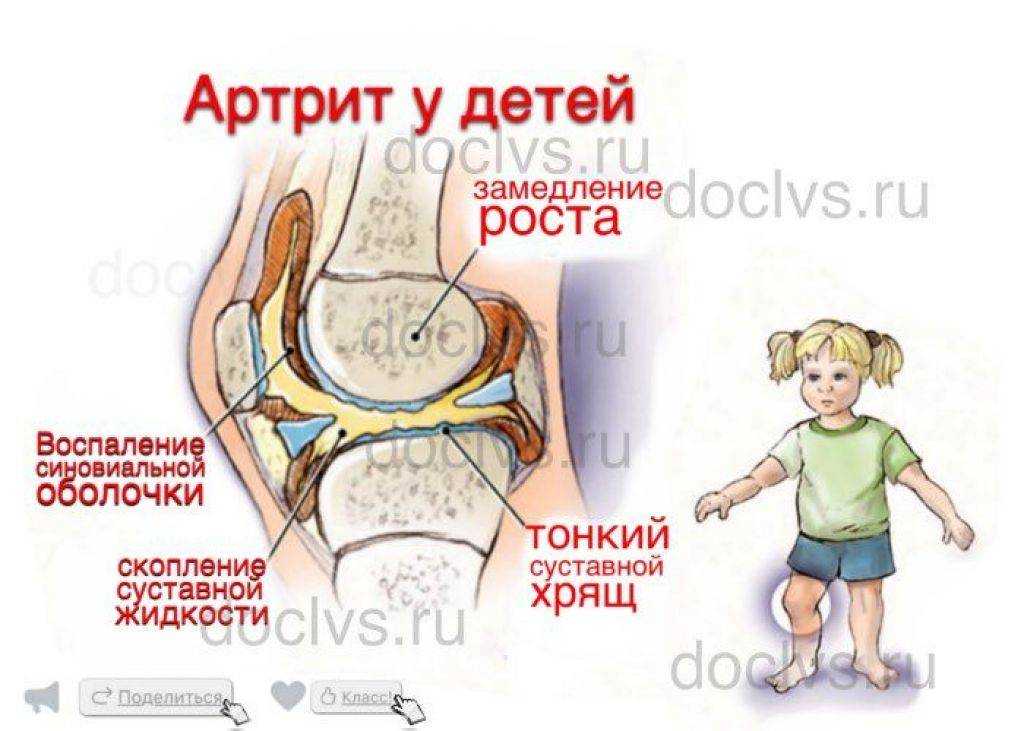 Суставы детей. Ювенильный идиопатический артрит коленного сустава. Ревматоидный артрит у детей. Профилактика артрита у детей. Воспаление суставов у детей.