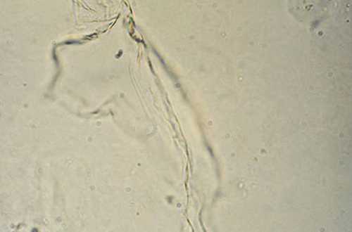Гомогенная слизь. Микроскопия мочи слизь. Слизь в моче микроскопия. Нити фибрина в моче микроскопия. Слизь в моче под микроскопом.