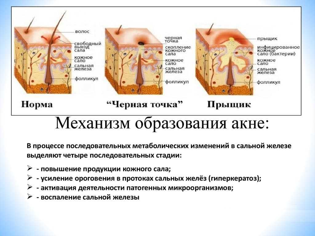 Борьба с черными точками чистками и пилингами