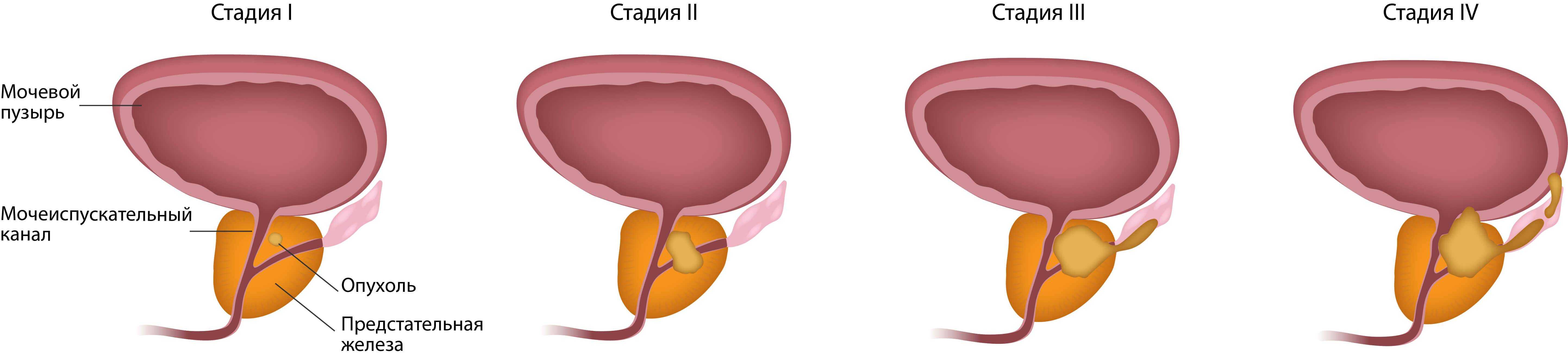 Рак простаты