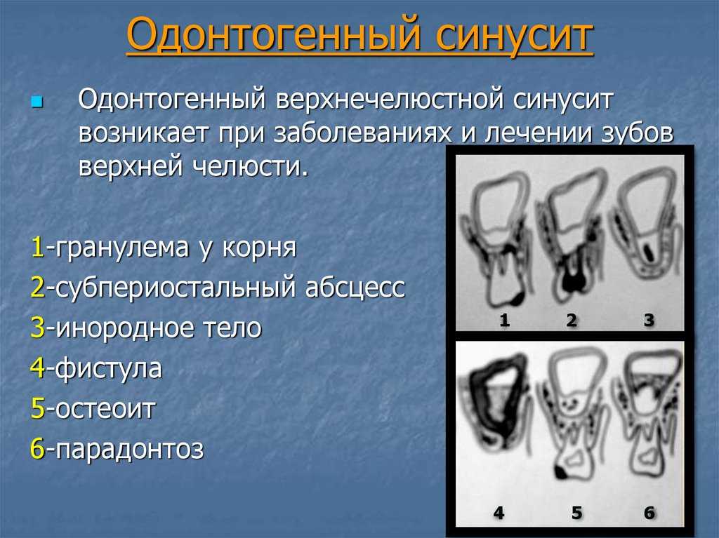 Острый синусит