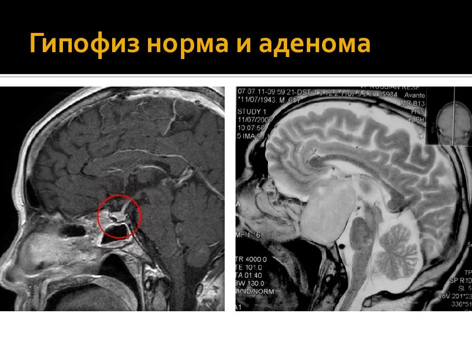 Микроаденома, макроаденома и нефункционирующая аденома гипофиза (nfpas), синдром гиперпролактинемии
