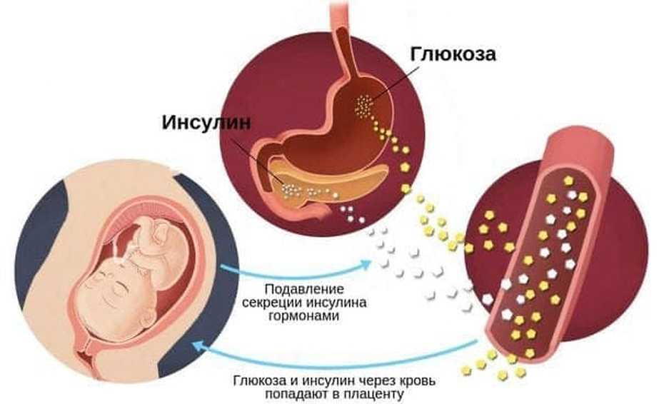 Гестационный сахарный диабет при беременности: чем опасен для ребенка, мамы