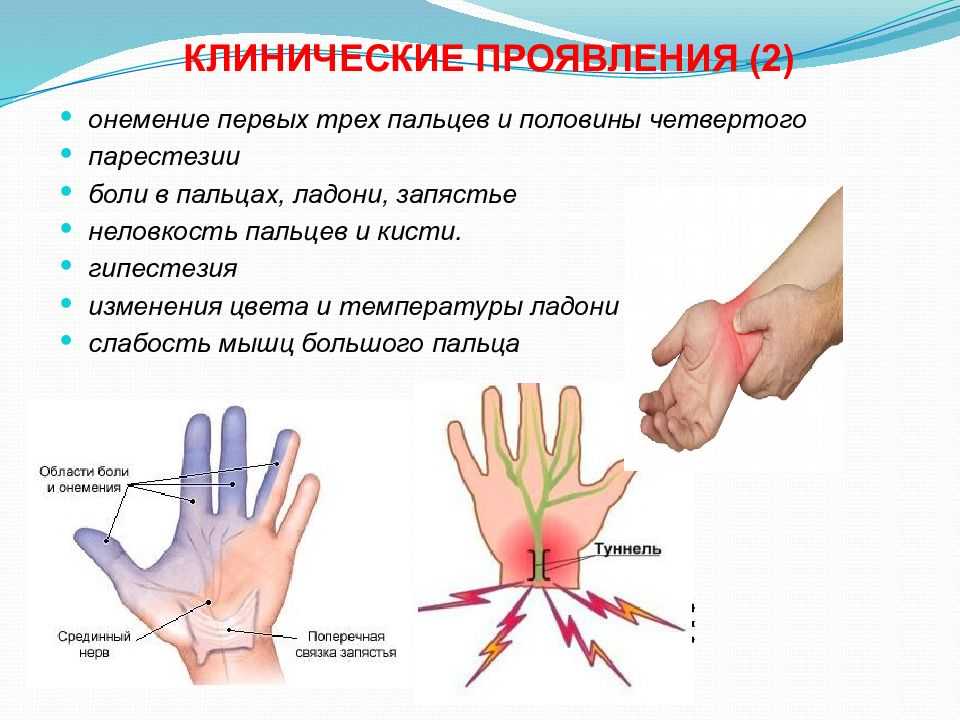 Почему немеют пальцы правой кисти. Синдром запястного канала руки. Туннельный синдром запястья кисти. Костевой ьуннельный синжрлм. Синдром лучезапястного канала.