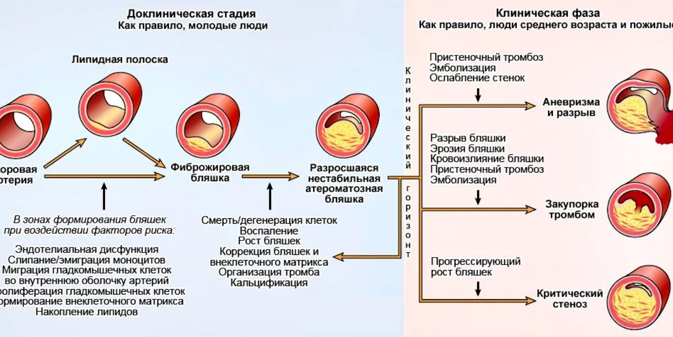 Атеросклероз головного мозга