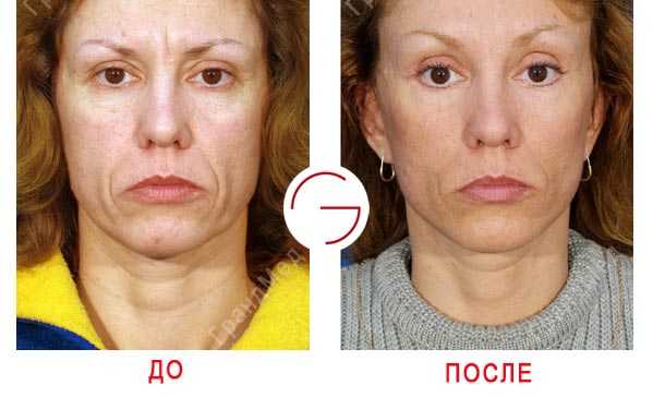 Жирная кожа лица: правильный ежедневный уход | блог expert clinics