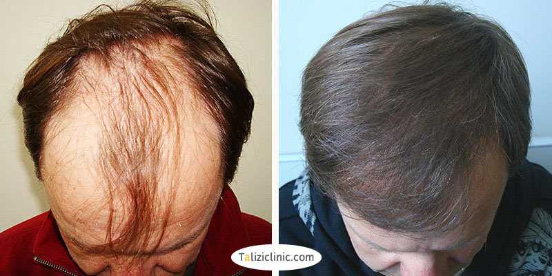 Выпадают волосы после операции. Андрогенная алопеция миноксидил. Дарсонваль алопеция андрогенная. Мезотерапия для волос до и после мужчины.