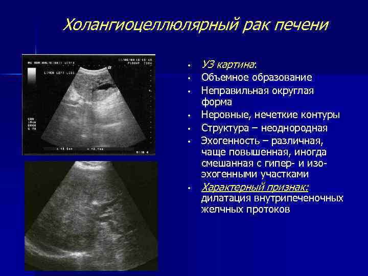 Заболевания печени на узи и в анализах