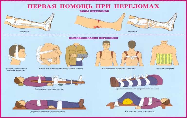 Первая помощь при переломах