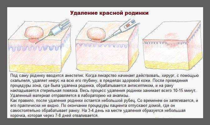 Удаление родинок на разных участках кожи: на голове, веке, ступне, ладони, губе, в подмышках, интимных областях