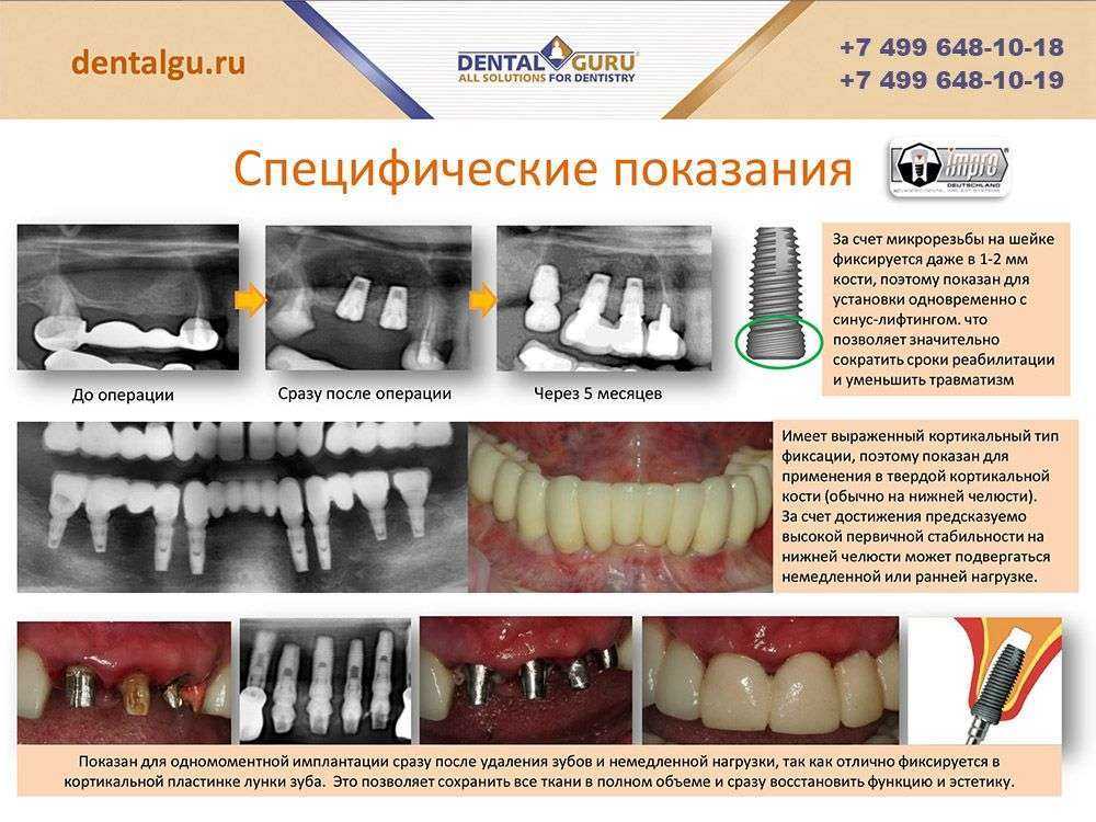 Схема установки имплантов зубов на нижней челюсти