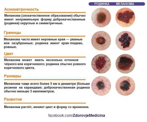 Меланома в начальной стадии: фото, симптомы, лечение