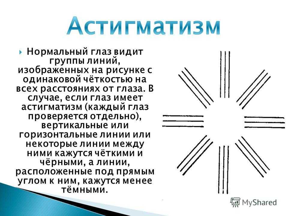 Астигматизм и его виды, особенности лечения астигматизма у детей