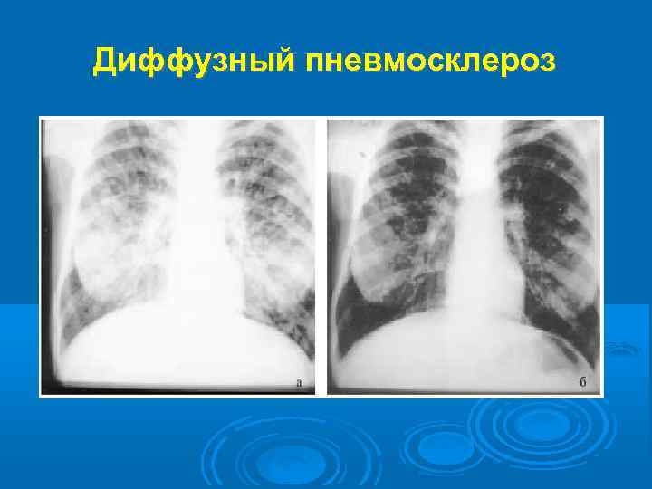 Диффузные изменения в легких. Посттуберкулезный пневмофиброз. Постпневмонический пневмосклероз. Диффузный пневмосклероз рентгенограмма.