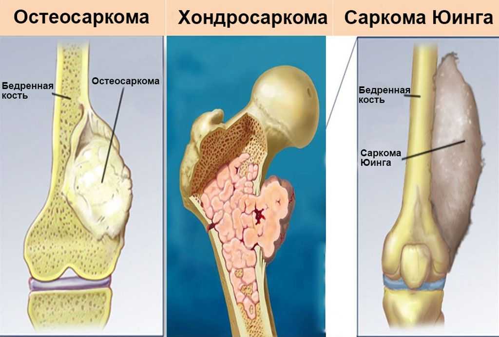 Опухоли костей схема