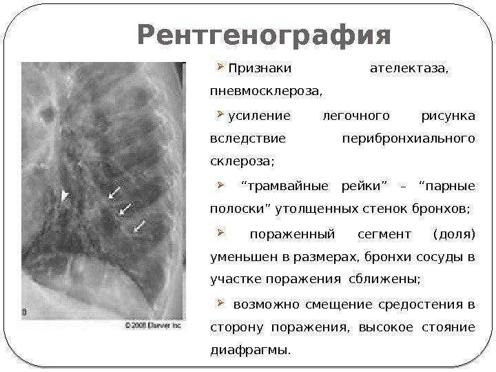 Легочный рисунок с признаками пневмосклероза что это значит у женщин