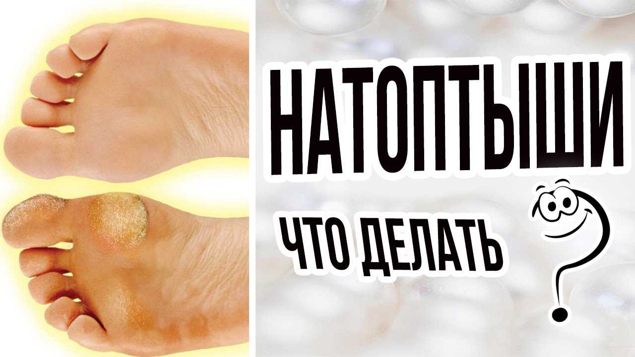 Рассказываем, как предотвратить появление мозолей и как от них избавиться, если они все же возникли | косметика aravia | дзен