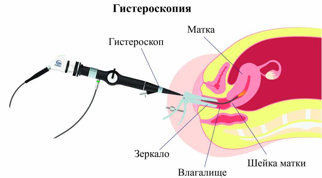 Гистероскопия