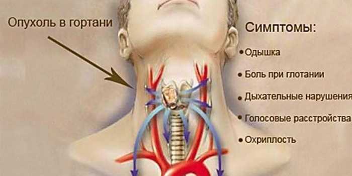 Боль ниже кадыка. Новообразования гортани.