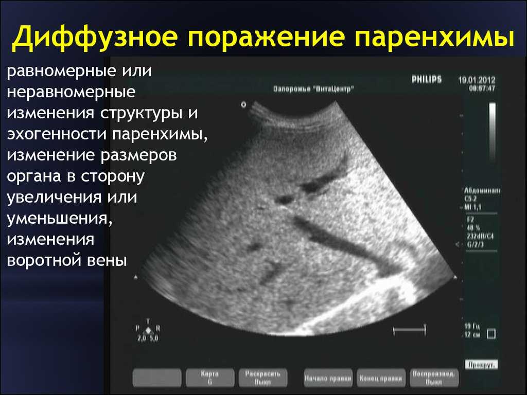 Эхо картина диффузных изменений паренхимы печени и поджелудочной железы