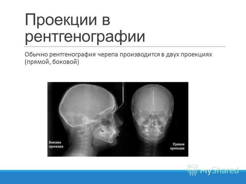 Рентгенография в двух проекциях. Рентген черепа норма заключение. Рентгенограмма черепа норма. Проекции черепа в рентгенографии. Рентгенография черепа заключение.