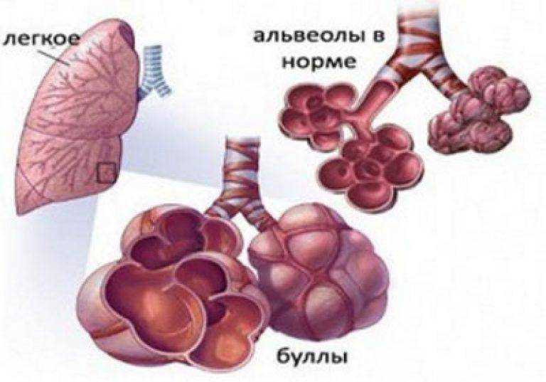 Буллы в легких картинки