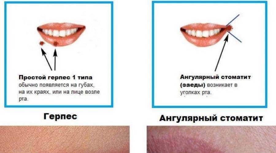 Хейлит: причины, симптомы и методы лечения