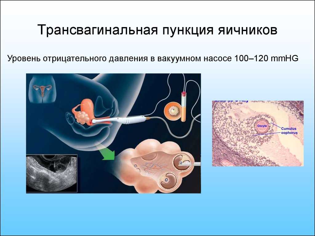 Овариальный резерв яичников — запас яйцеклеток ограничен