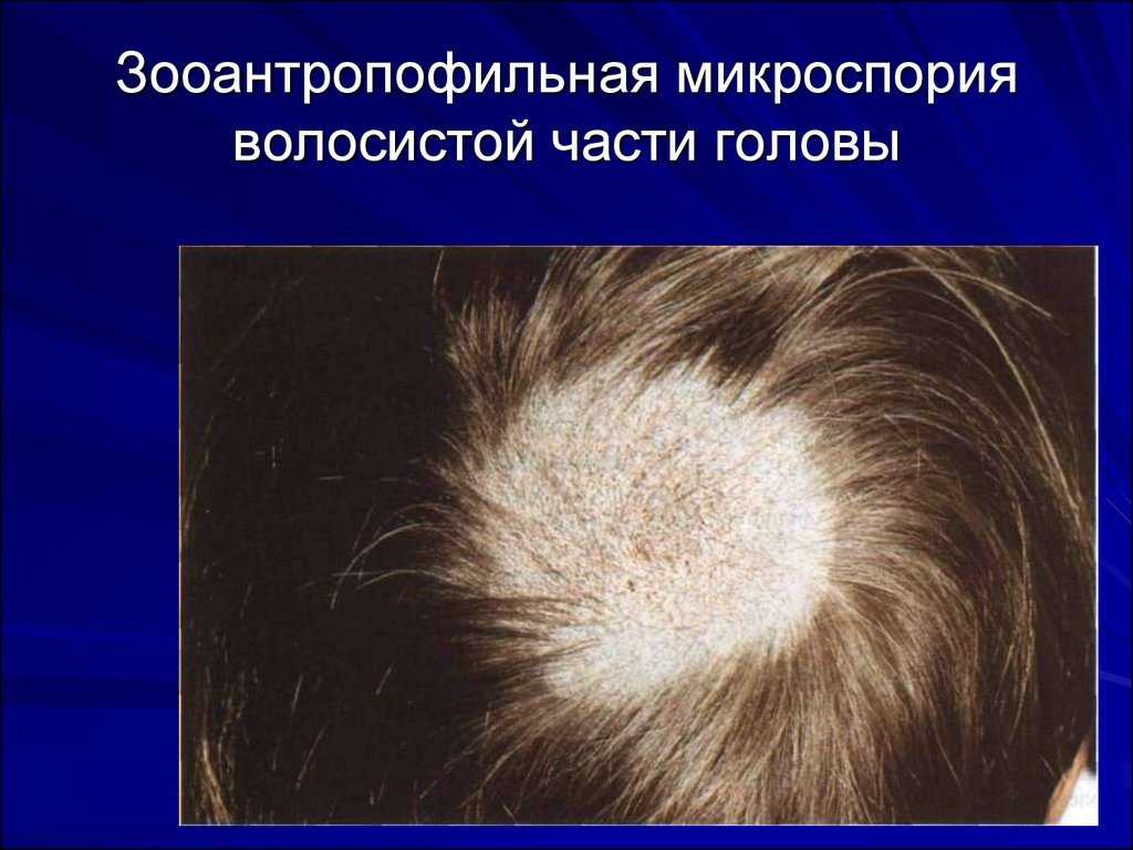 Стригущий лишай | симптомы | диагностика | лечение - docdoc.ru