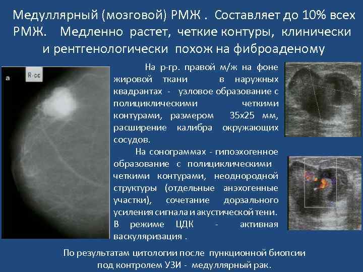 Рак молочной железы