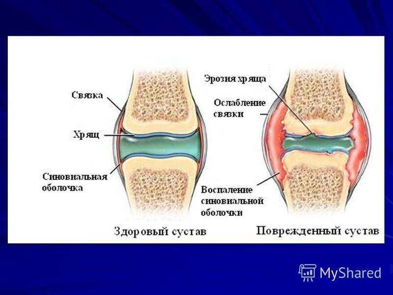 Ревматоидный артрит: симптомы, диагностика