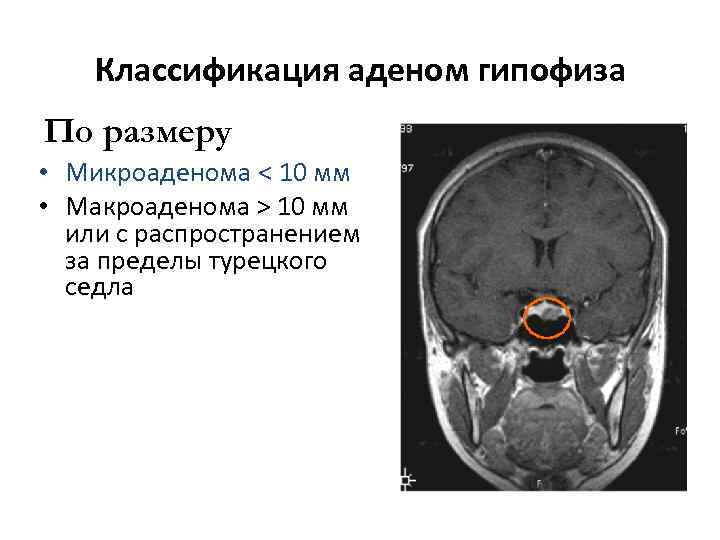Аденома гипофиза
