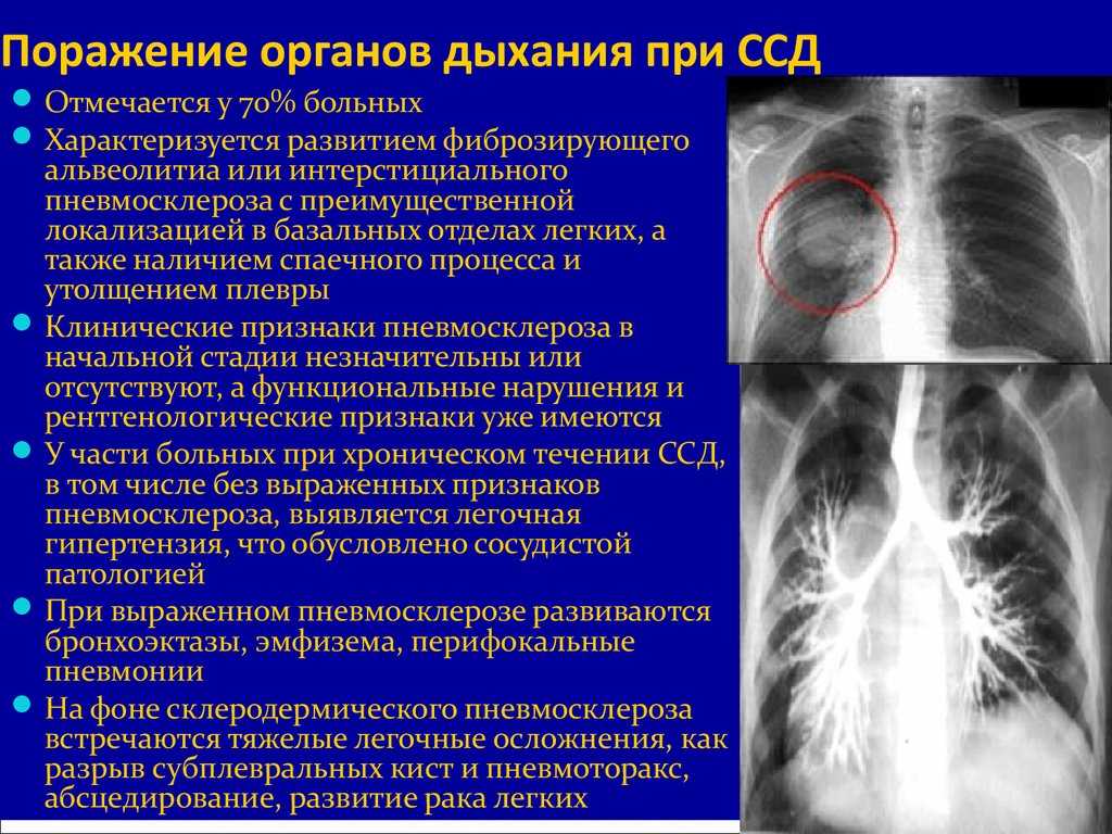 13 причин развития и прогрессирования диффузного пневмосклероза лёгких